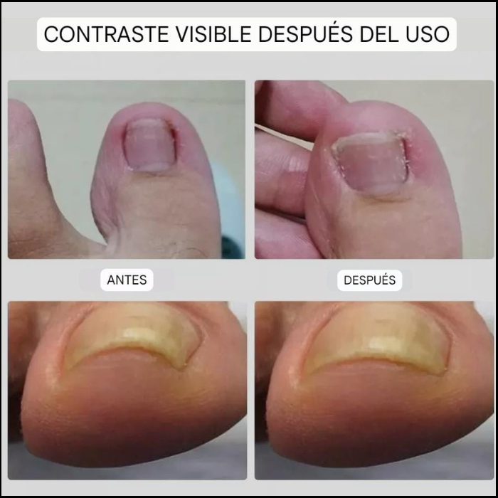 🦶 Anti Hongo ToenailPlus – Elimina Hongos de Uñas de Manera Eficaz y Rápida 🦶